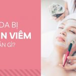 bị mụn viêm nên ăn gì