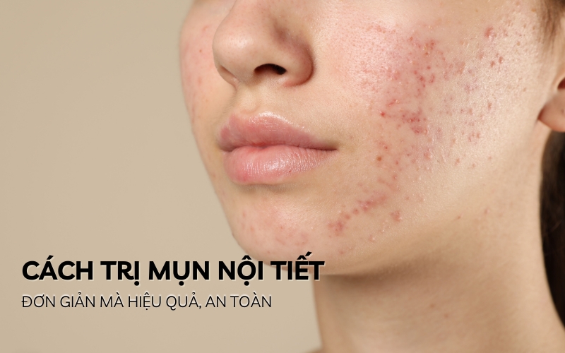 cách trị mụn nội tiết