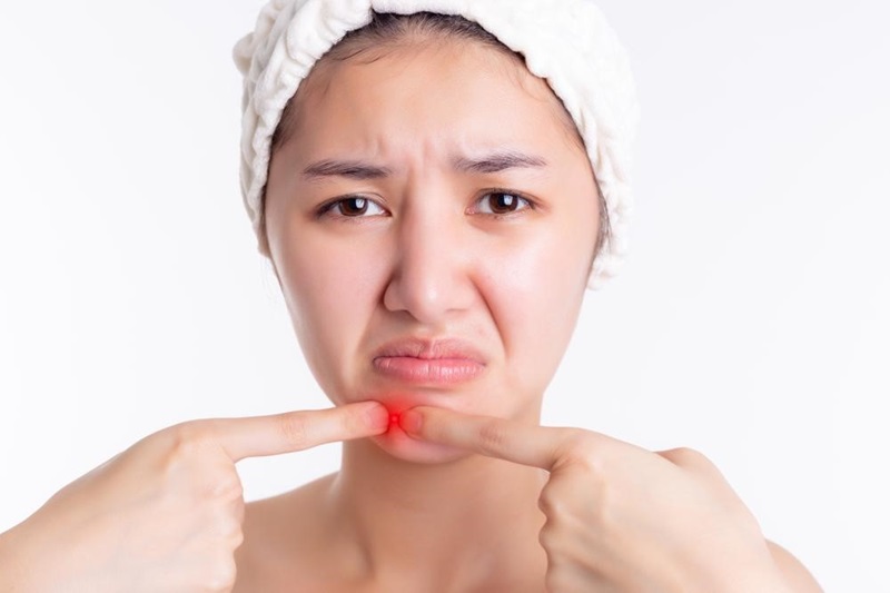 có nên nặn mụn không