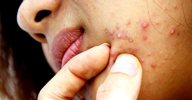 hướng dẫn xử lý mụn mủ